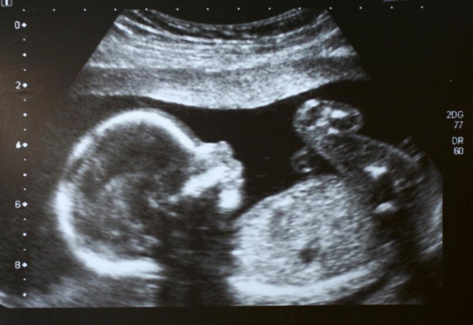 25 Недель Беременности Фото Ребенка На Узи